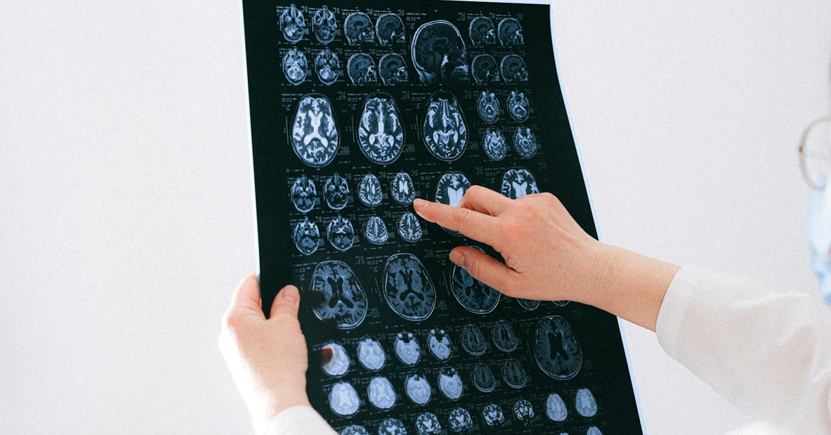 An MRI scan of the brain | ©Image Credit: Anna Shvets/Pexels